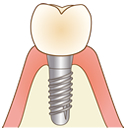 インプラント